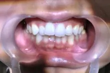 親知らず抜歯体験2