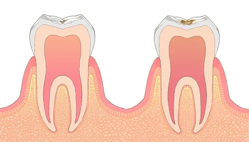 歯石除去をしないと虫歯や歯周病の原因になります。