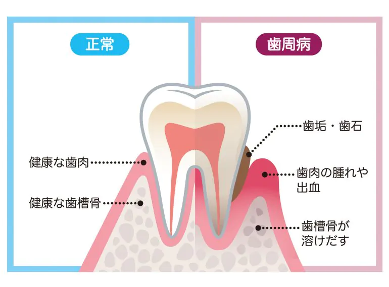 歯石と歯周病について
