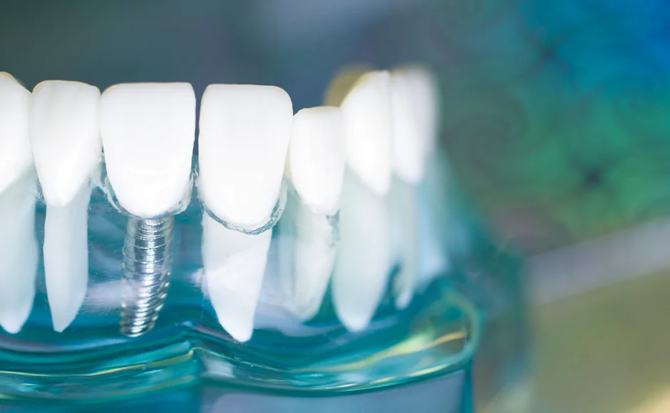 Invisalign AND Implantology