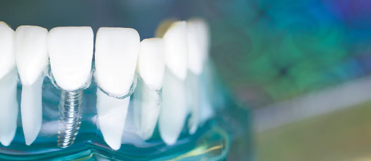 Invisalign AND Implantology